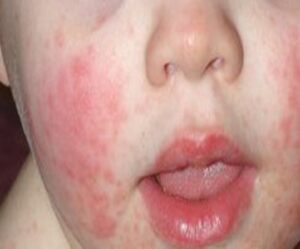 Slapped Cheeks Virus